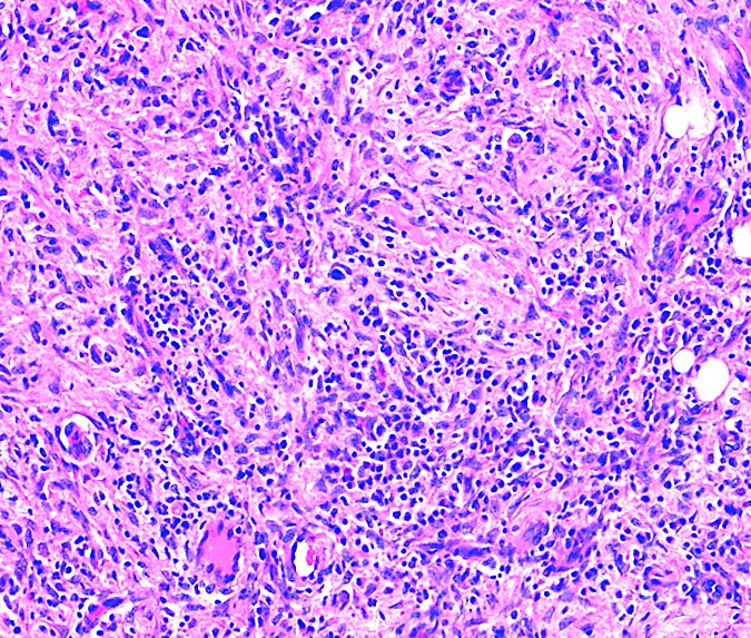 Pathology Outlines Inflammatory Pseudotumor 